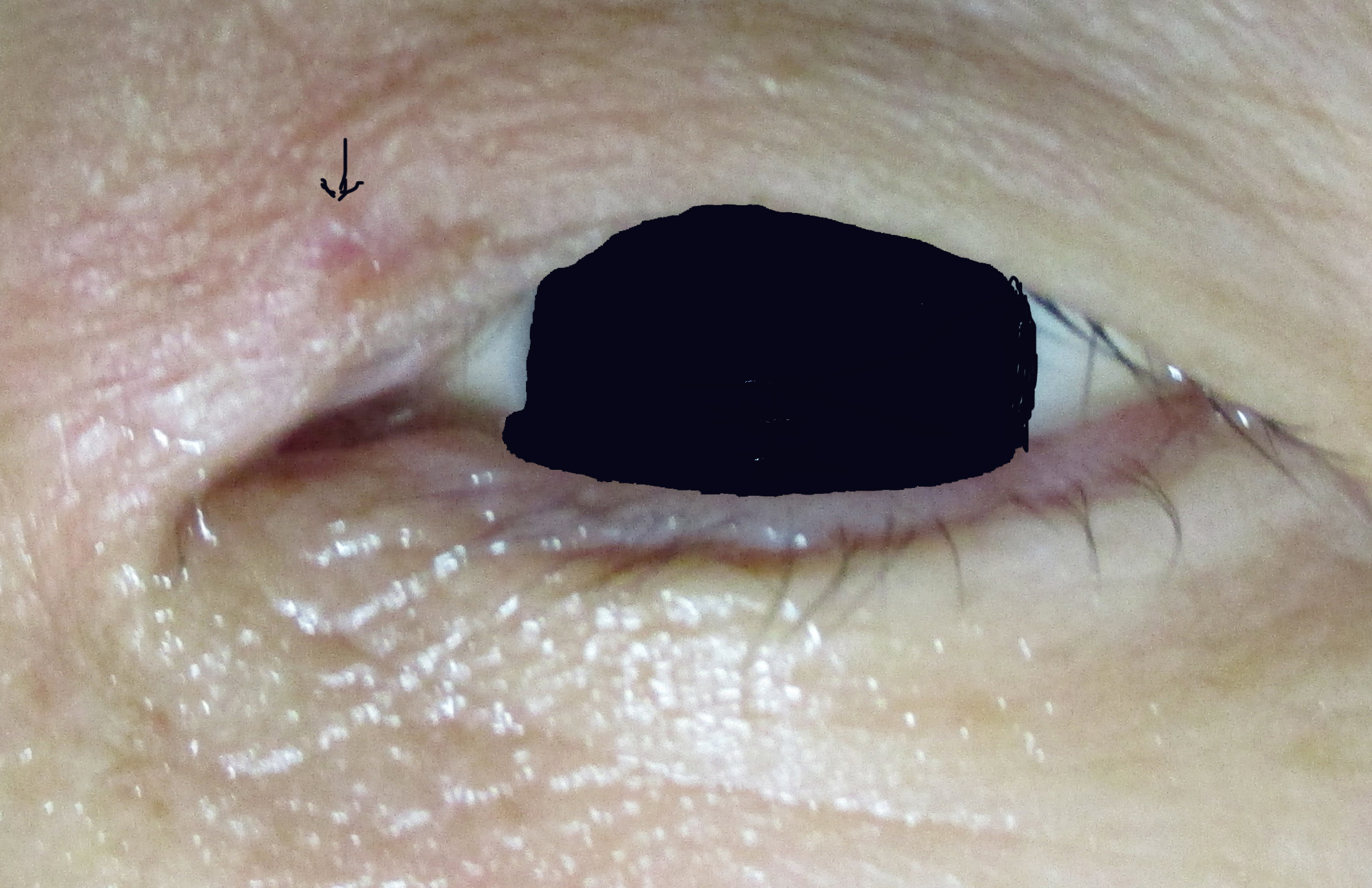 瞼の 粉瘤腫　レーザー照射による摘出後